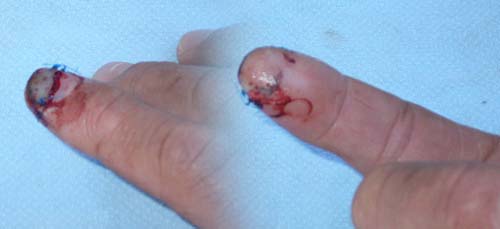 Severed Fingertip